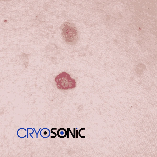 Looking for pain free cherry angioma removal treatment Derby? Call our team today! Derby
