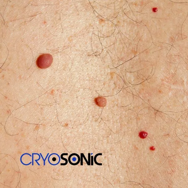 get cherry angioma removal treatment today! Derby
