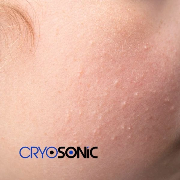 Are you looking for milia removal treatment? Contact our team today Derby