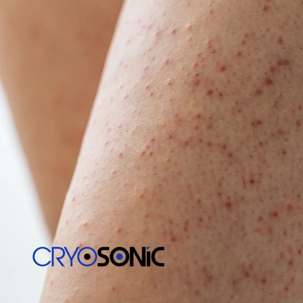 Looking for Seborrhoeic Keratosis removal Derby treatment? Call our consultants today in Derby