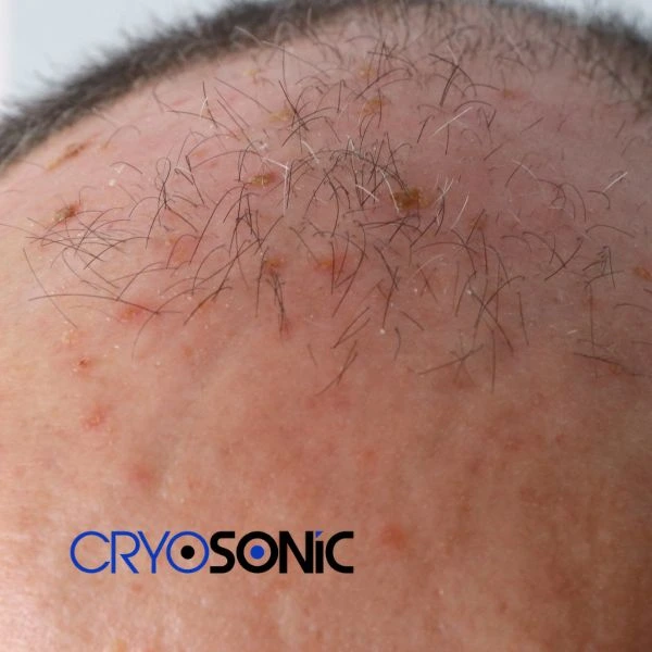Access Seborrhoeic Keratosis removal from the comfort of your own home! Call us today in Derby