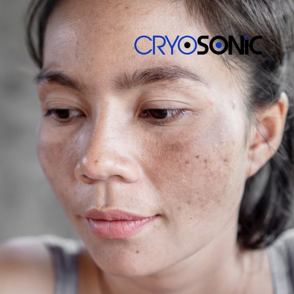 Ready to start age spots removal? Contact our team today in Derby