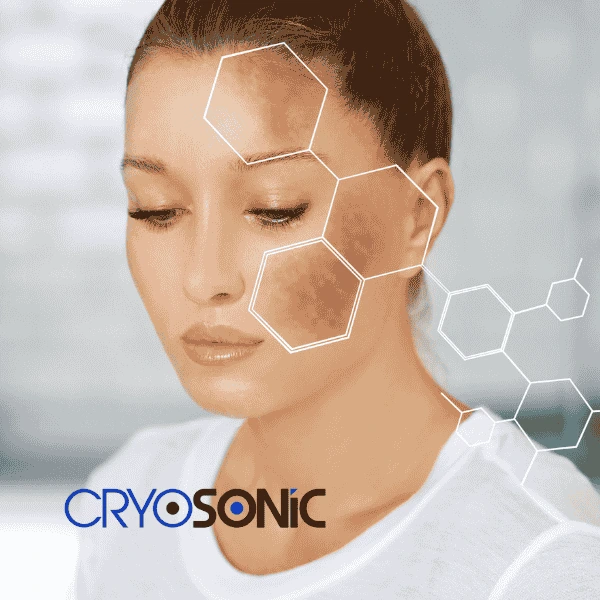 Are you looking for age spot removal treatment? Contact Cryosonic today in Derby