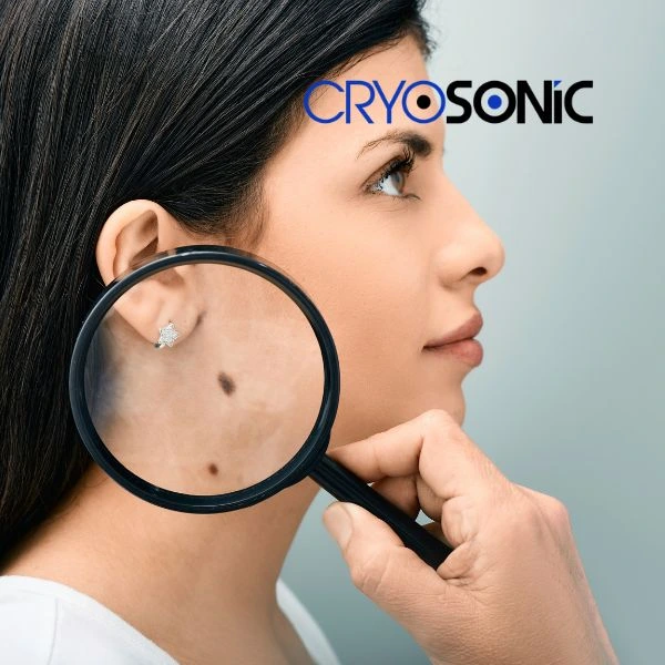 Do you want to learn more about benign moles removal treatment? Call our team today Derby