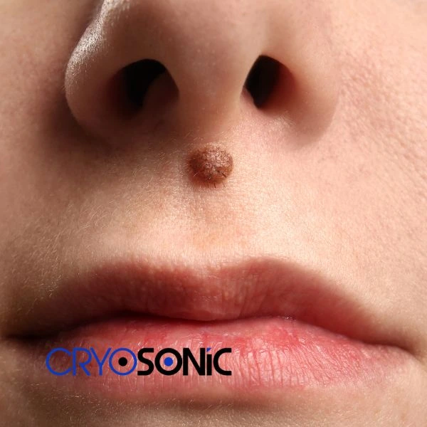 Start your benign moles removal treatment today Derby