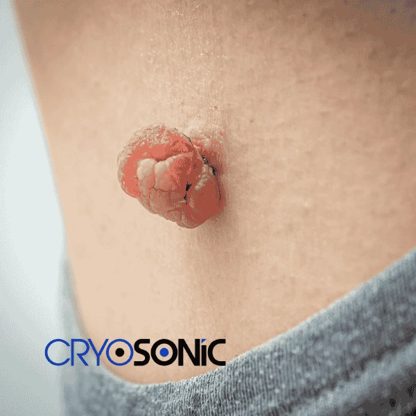 Book your skin tags removal Derby from comfort of your own home! Derby