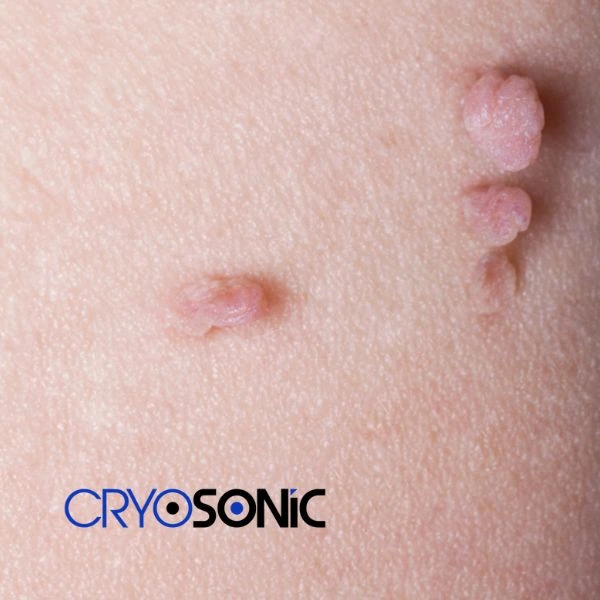 Are you looking for fast effect skin tag removal Derby? Book in NOW! Derby