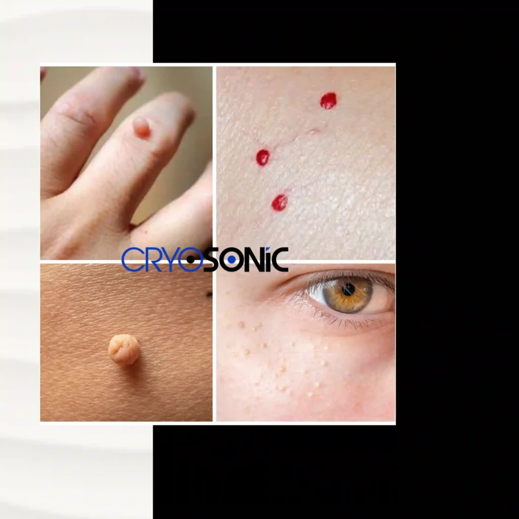What Are the Different Types of Benign Skin Lesions – and How They’re Treated with CryoPen Derby