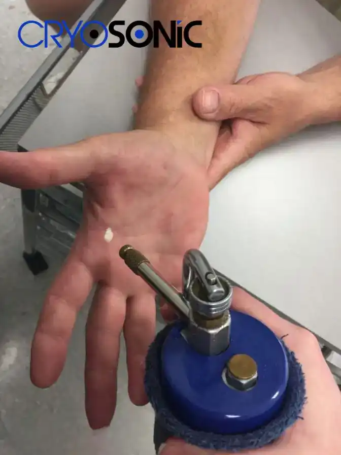 Temperature Differences: OTC vs Medical-Grade Cryotherapy Derby